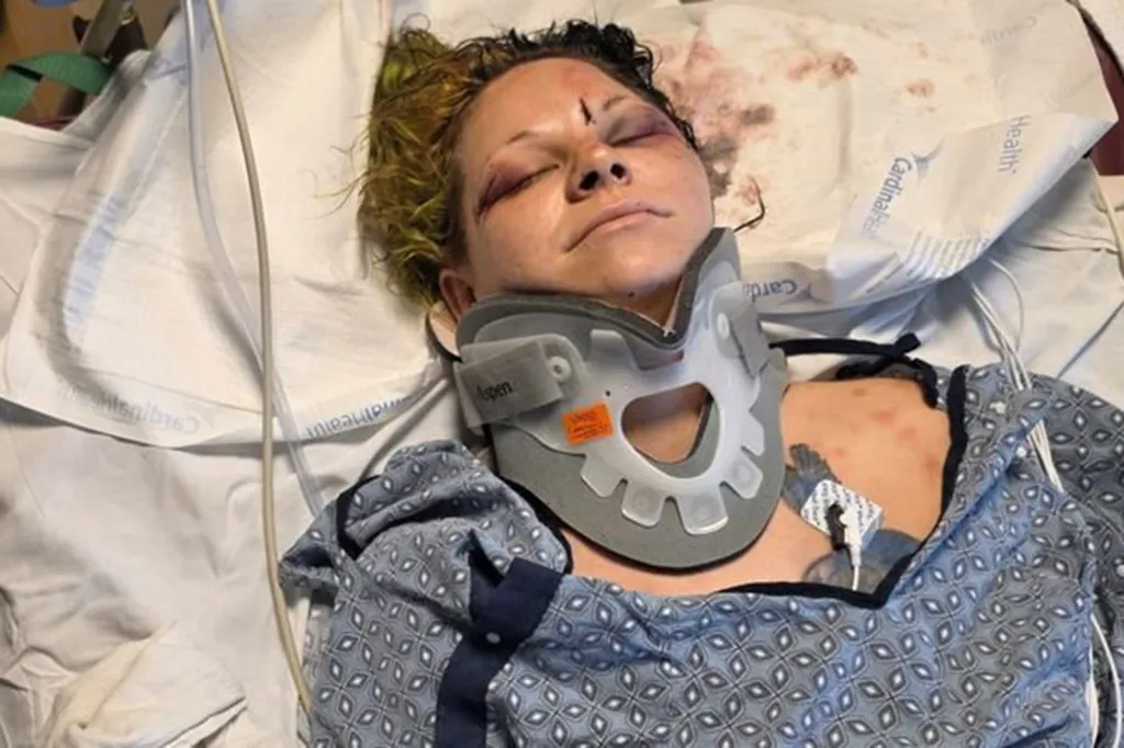 A woman with visible facial injuries and a neck brace lies in a hospital bed.