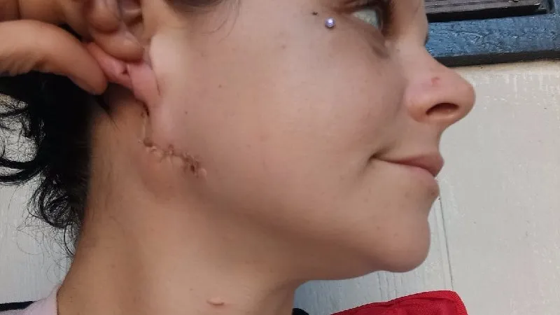 Close-up profile of a woman showing a stitched wound on her jawline near her right ear.
