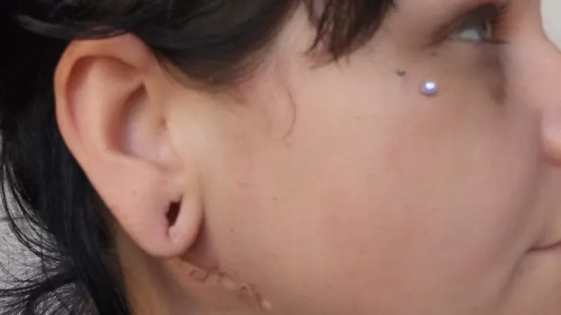 Close-up of a woman's face and neck, showing a scar running from her jawline toward her neck below her ear.