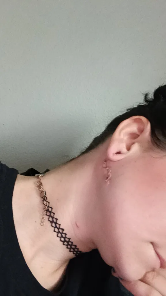 A close-up of a scar on the side of a woman's neck, just below her ear.